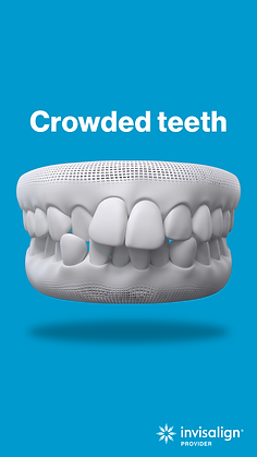 3D scanning for invisalign