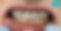 clear-braces-ceramic-brackets-na-orthodontics-nj.jpg