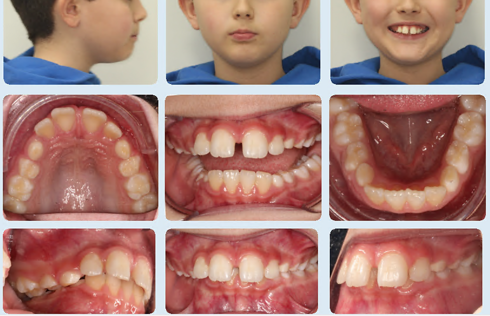 Invisalign Kids - Start