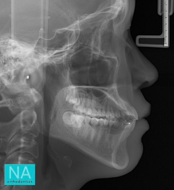 Profile before Invisalign
