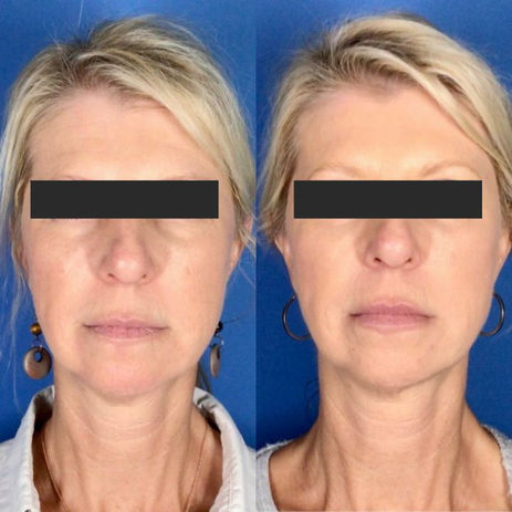 patient front face image showing before and after a skinveve treatment