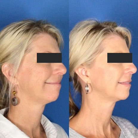 patient profile image showing right side of face before and after a skinveve treatment