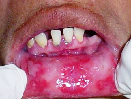 ¿Sabías que algunas enfermedades autoinmuenes pueden afectar tu salud bucal?