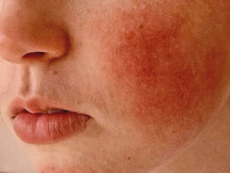 Best Éminence Products for Rosacea