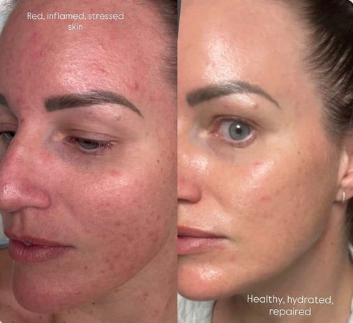 Impaired skin barrier repair