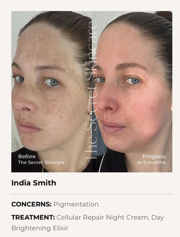 Pigment acne age concerns