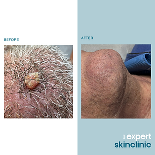 Before- After – 52.png