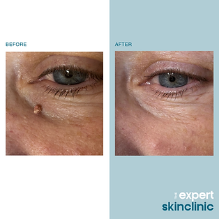 Before- After – 51.png