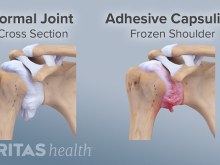 Frozen Shoulder and physio.  