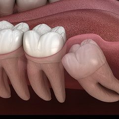 Zen Dental Center in Capitol Hill, Seattle, WA 98102 Family Cosmetic Emergency Implants - Dental Checkup, Cleaning and Examinations, Crowns, Bridges, Implants, Restorations, Veneers, Tooth Extractions, Teeth Whitening, ClearCorrect, Dentures, Partial Dentures, Emergency Dentist, Invisalign Dentist, Kid Friendly Dentist, Periodontics, Root Canal Therapy