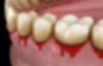 Zen Dental Center in Capitol Hill, Seattle, WA 98102 Family Cosmetic Emergency Implants - Dental Checkup, Cleaning and Examinations, Crowns, Bridges, Implants, Restorations, Veneers, Tooth Extractions, Teeth Whitening, ClearCorrect, Dentures, Partial Dentures, Emergency Dentist, Invisalign Dentist, Kid Friendly Dentist, Periodontics, Root Canal Therapy