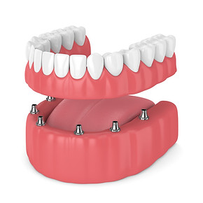 Zen Dental Center in Capitol Hill, Seattle, WA 98102 Family Cosmetic Emergency Implants - Dental Checkup, Cleaning and Examinations, Crowns, Bridges, Implants, Restorations, Veneers, Tooth Extractions, Teeth Whitening, ClearCorrect, Dentures, Partial Dentures, Emergency Dentist, Invisalign Dentist, Kid Friendly Dentist, Periodontics, Root Canal Therapy