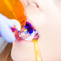 Zen Dental Center in Capitol Hill, Seattle, WA 98102 Family Cosmetic Emergency Implants - Dental Checkup, Cleaning and Examinations, Crowns, Bridges, Implants, Restorations, Veneers, Tooth Extractions, Teeth Whitening, ClearCorrect, Dentures, Partial Dentures, Emergency Dentist, Invisalign Dentist, Kid Friendly Dentist, Periodontics, Root Canal Therapy