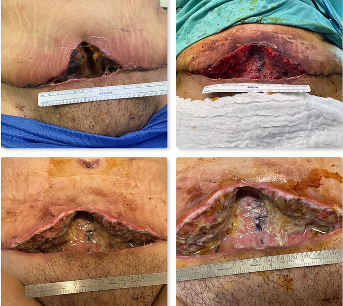 PANEL 1 (breakdown, debridement, 24h, 48h).jpg
