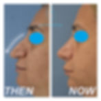 ΕΠΑΝΑΛΗΠΤΙΚΗ ΡΙΝΟΠΛΑΣΤΙΚΗ (revision rhinoplasty)