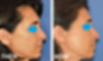 HYPPP-Lift right profile/ΧΙΠ-ΛΙΦΤΙΝΓΚ
