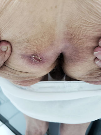 Decubitus ulcer at stage 3 on a male patient.jpg