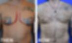 GYNAECOMASTIA CORRECTION & CHEST LIPOSCULPTURE (ΔΙΟΡΘΩΣΗ ΓΥΝΑΙΚΟΜΑΣΤΙΑΣ)