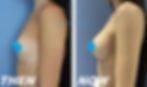 Breast Augmentation (ΑΥΞΗΤΙΚΗ ΜΑΣΤΩΝ)