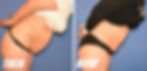 ΚΟΙΛΙΟΠΛΑΣΤΙΚΗ (tummy tuck)