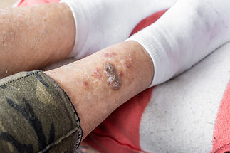 Ulcers and skin diseases, dried scabs and fresh wounds on the legs of an elderly woman, He