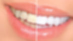 SBIANCAMENTO DENTALE