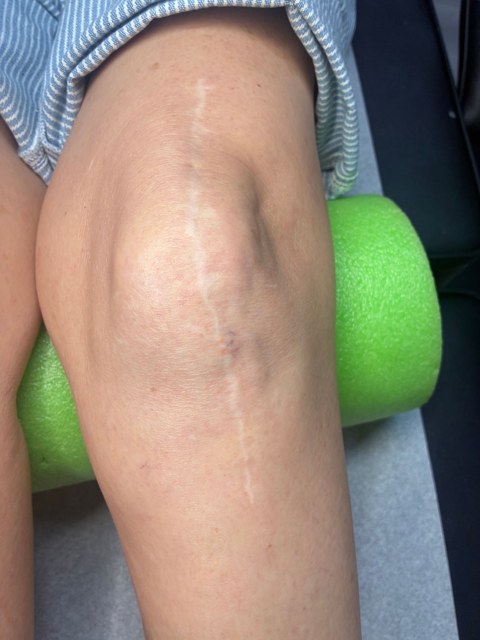 Knee Incision Scar Camouflage in St. Petersburg, FL