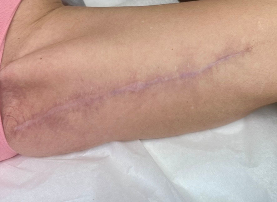 Scar Camouflage Tattooing for Dunedin and the Surrounding Pinellas Communities