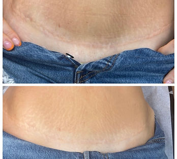 safety harbor tummy tuck scar camouflage tattoo