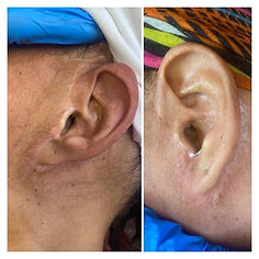 face lift scars around the ears scar camouflage tattoo
