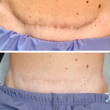 Dark scar camouflage tattoo in tampa bay, st petersburg florida
