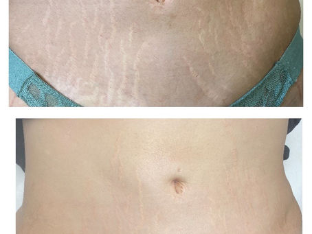 Should I Get Laser or Camouflage Tattoo for Stretch Marks?