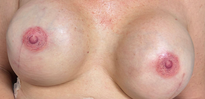 before and after areola tattoos in sarasota florida