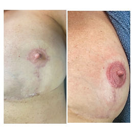 breast lift scar tattooing
