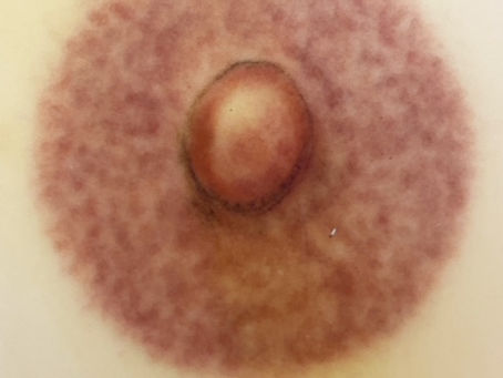 Mastectomy Scar Camouflage: Gently Blending Chest Scars After Breast Cancer