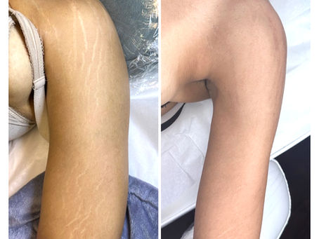 Paramedical Tattoo Training in Florida & North Carolina: What to Look For in a Quality Program