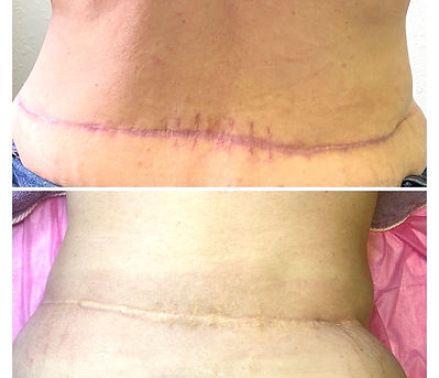 training for scar camouflage tattoo_edit