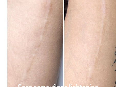 Why Your Surgery Scar Turned White and Won't Fade