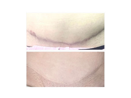 Medical PMU After Tummy Tuck, Breast Lift, and Other Plastic Surgery Procedures