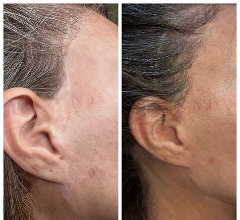 Before and after facelift scar camouflage tattoo St. Petersburg Florida by Bianca Cypser