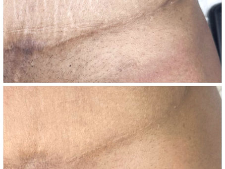 Tummy Tuck Scar Camouflage: Blending a Healed Abdominoplasty Scar