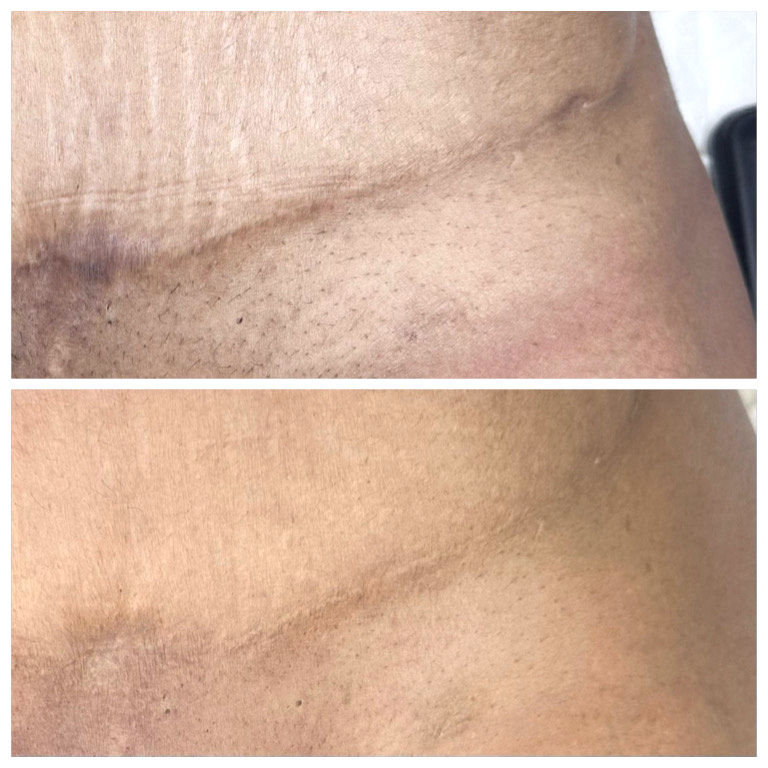Tummy Tuck Scar Camouflage: Blending a Healed Abdominoplasty Scar
