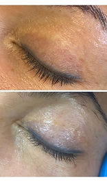 upper eyelid surgery scar camouflage tattoo blepharoplasty