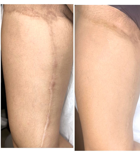 scar camouflage tattoo on dark skin_edited_ed