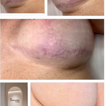 breast lift reduction red scar camouflage tattoo florida