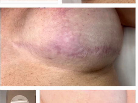 Breast Reduction Scars: What to Expect and How to Get Rid of Red and Purple Scar