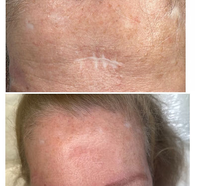 scar cover tattoo face scar tampa bay paramedical tattoo