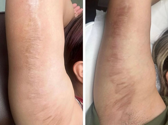 dark brachioplasty scarring before and after paramedical tattooing using medical tattoo ink. scar cover tattoo also known as scar camouflage shows the difference after the procedure