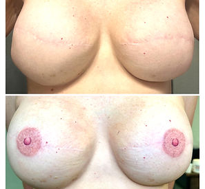 3D nipple tattoo after mastectomy Tampa Florida