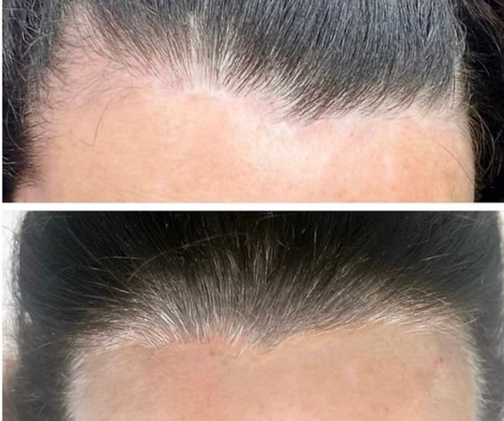 Forehead incision before and after scar camouflage tattoo showing blended facelift scar along the hairline